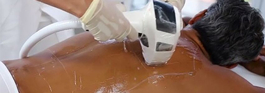 Alta tecnologia na depilação a laser