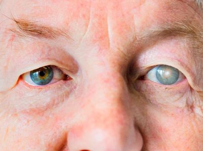 Catarata, a doença que aumenta cada vez mais no Brasil!!!