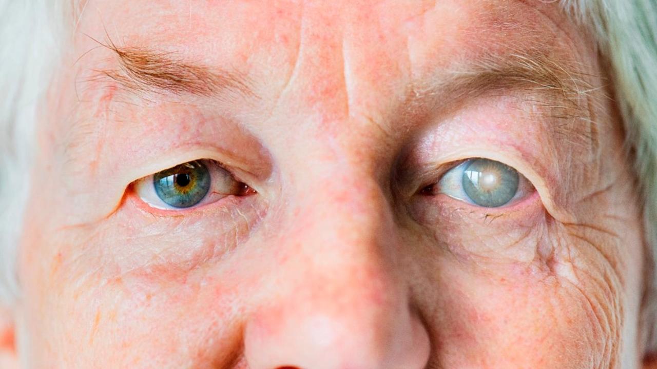 Catarata, a doença que aumenta cada vez mais no Brasil!!!