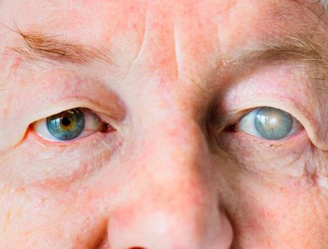 Catarata, a doença que aumenta cada vez mais no Brasil!!!